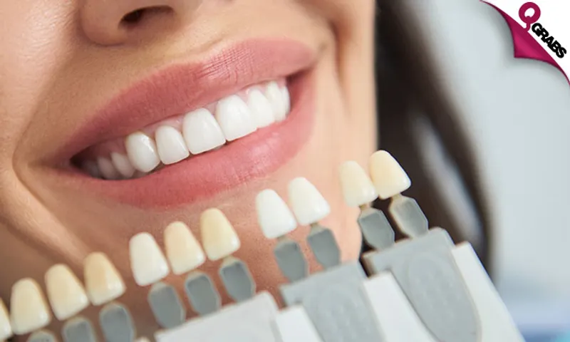 Direct Composite Veneers & Flouride Teeth Varnish!